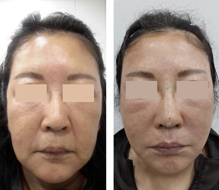 ミタム独自の二重筋膜固定法によるスレッドリフトで、確実なVライン効果をより長く維持することができます。