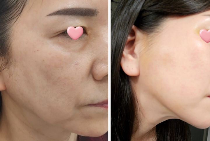 ミタム独自の二重筋膜固定法によるスレッドリフトで、確実なVライン効果をより長く維持することができます。