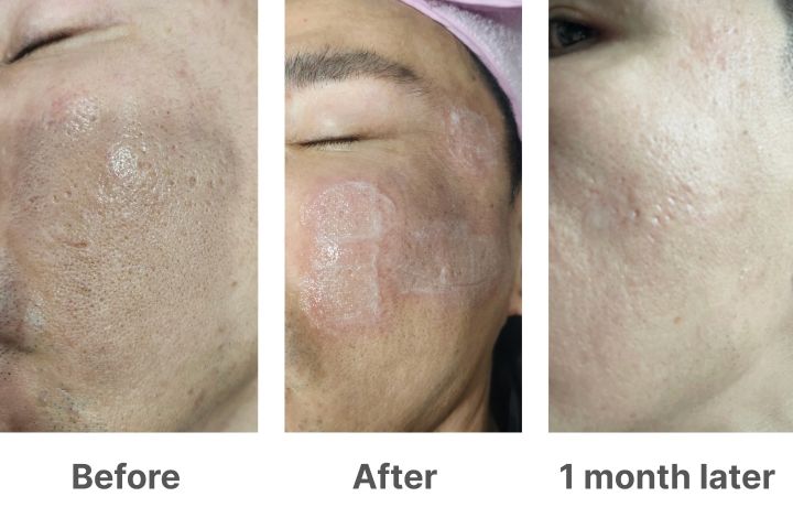 凹んだニキビ跡が改善されたことをご確認いただけます。 プレミアムレーザー施術1回目の前後写真です。