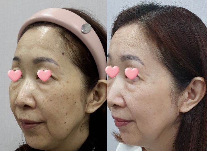 施術前後のお写真です。トリプルレーザーで色素沈着を改善し、肌の明るさと透明感を引き出しました。