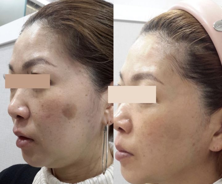 施術前後のお写真です。トリプルレーザーで色素沈着を改善し、肌の明るさと透明感を引き出しました。