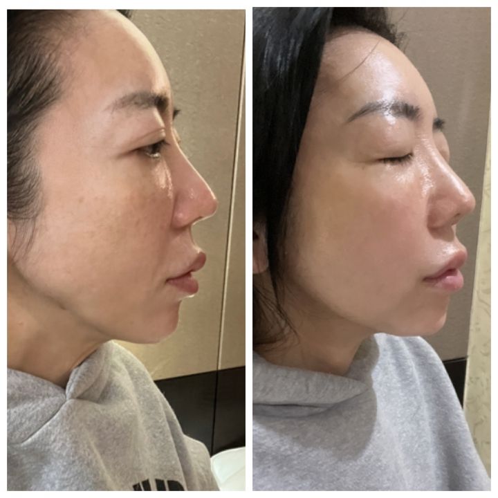 ハリがでてほうれい線も薄くなりました