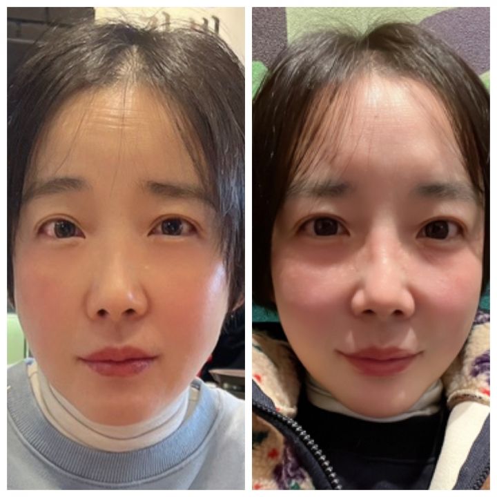 頬がリフトアップされフェイスラインもスッキリ。おでこのシワも目立ちません。